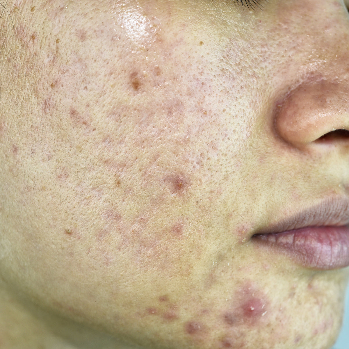 Breakouts