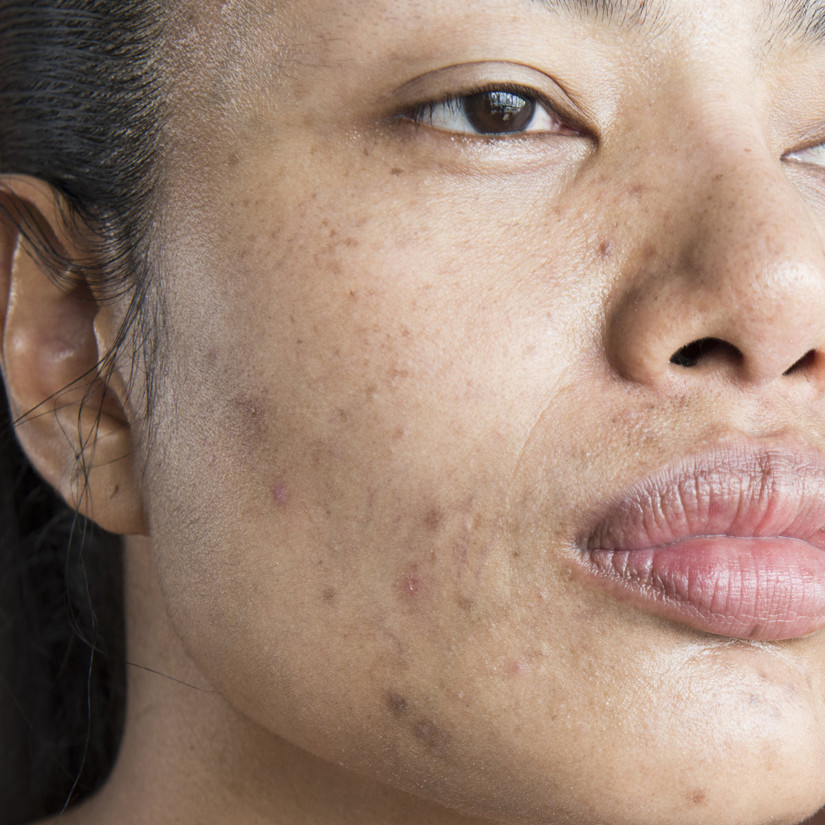 Dark Spots & Hyperpigmentation